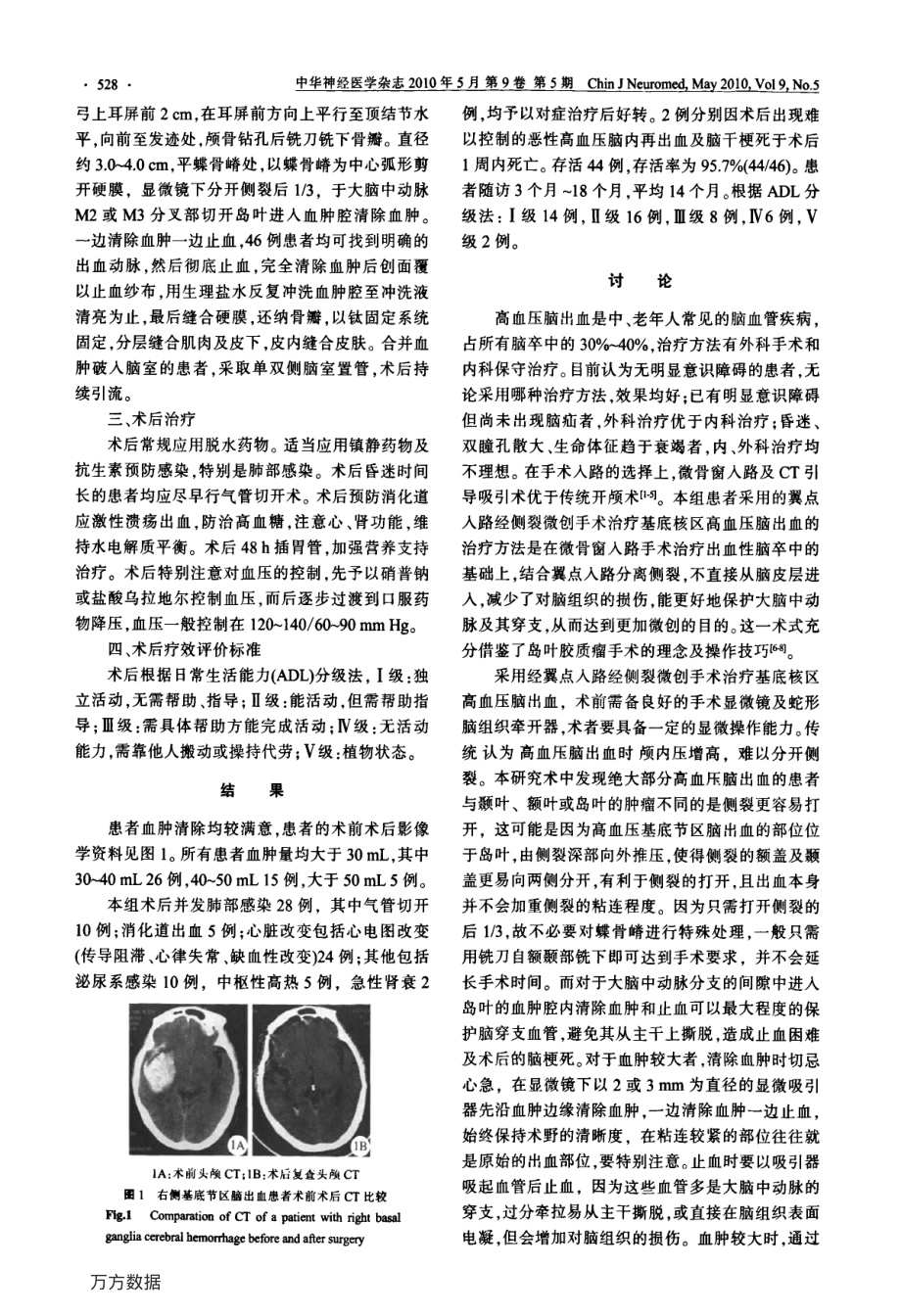 翼点入路经侧裂显微外科手术治疗基底节区高血压脑出血.pdf_第2页