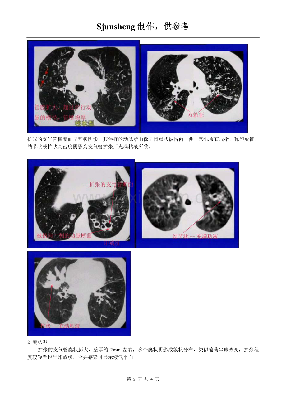 支气管扩张的CT图像.pdf_第2页