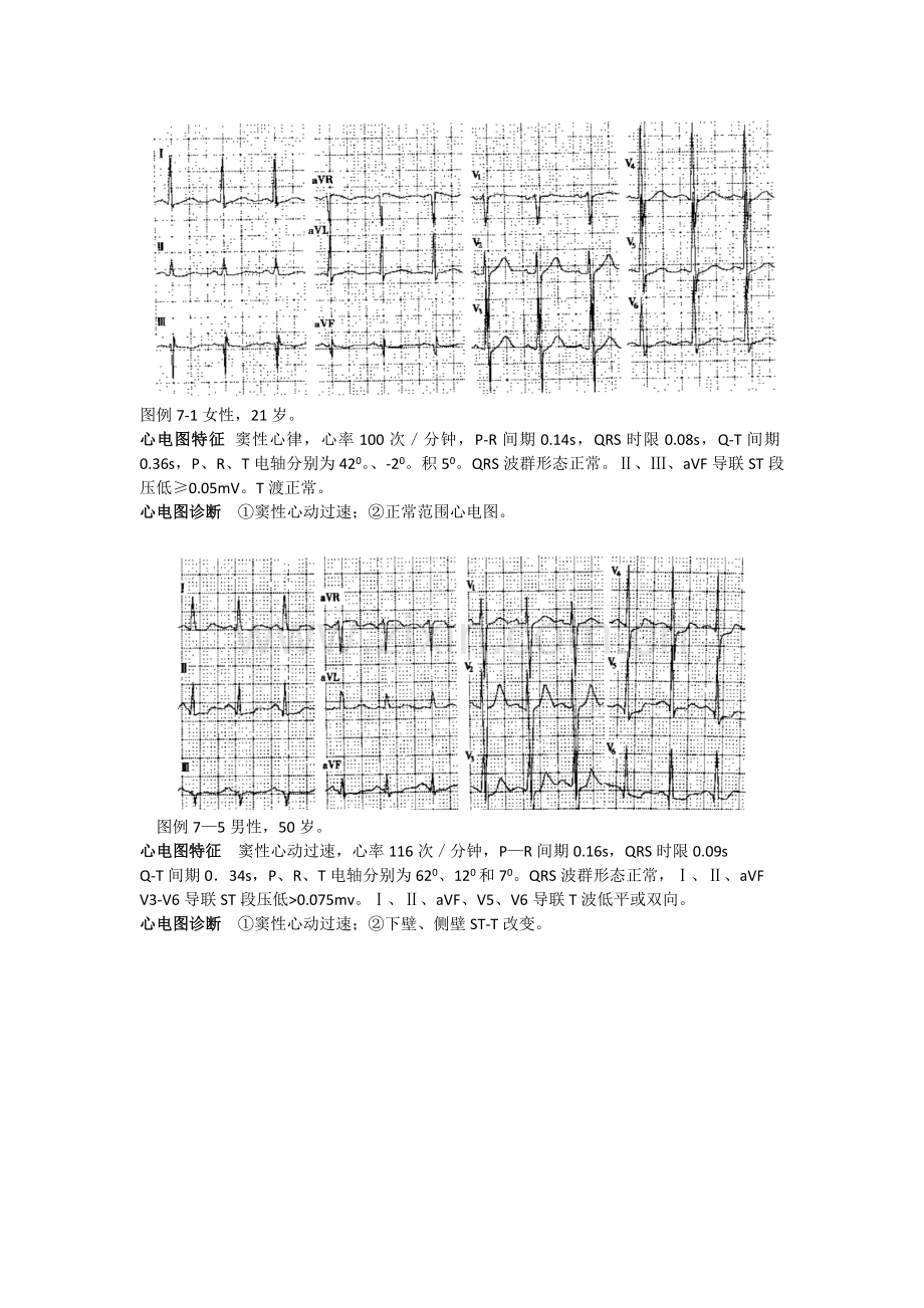 窦性心律失常.docx_第3页