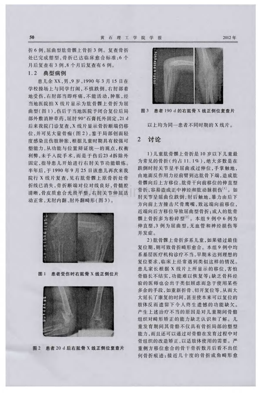 从儿童肱骨髁上骨折畸形愈合看儿童骨骼组织的塑型能力.pdf_第2页