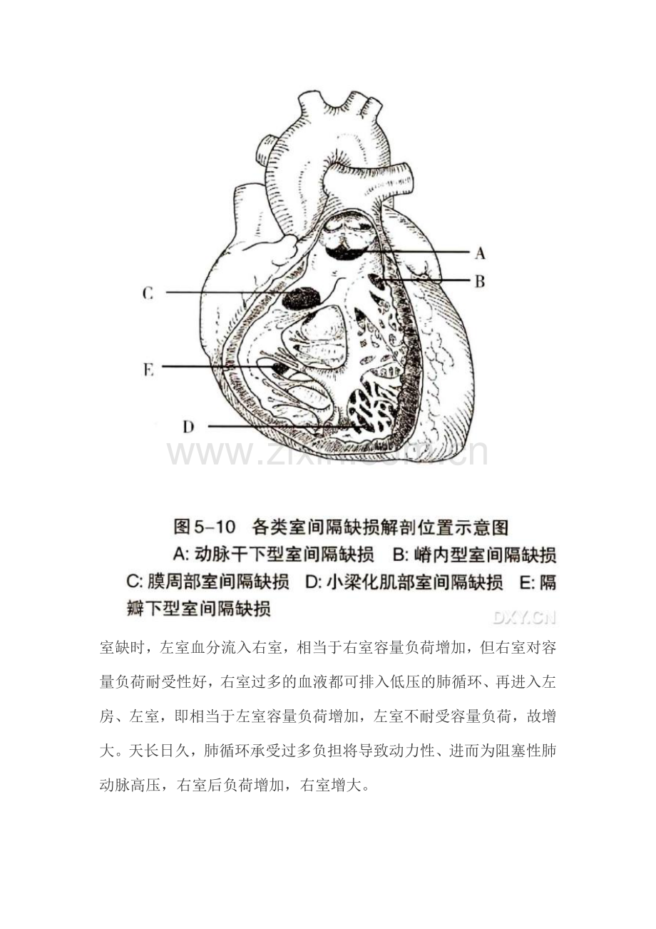 室间隔缺损分型.doc_第3页