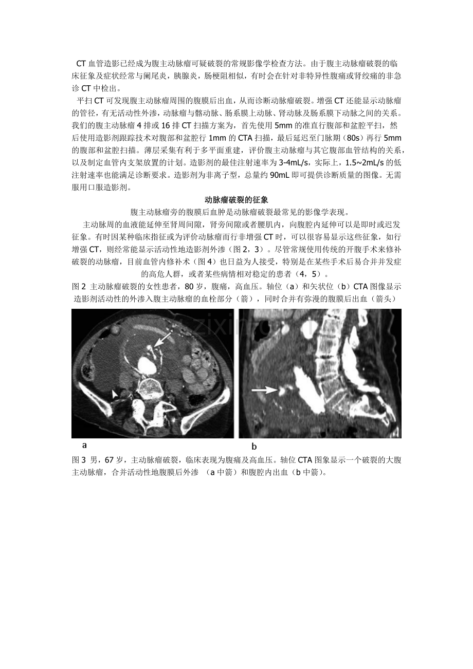 腹主动脉瘤破裂及先兆破裂的CT征象.docx_第2页