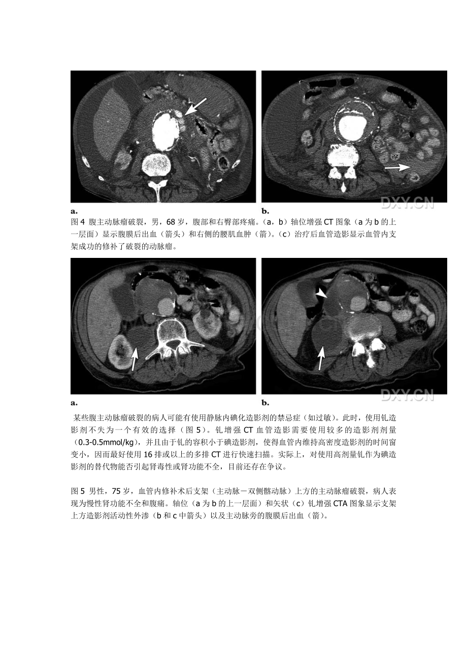 腹主动脉瘤破裂及先兆破裂的CT征象.docx_第3页