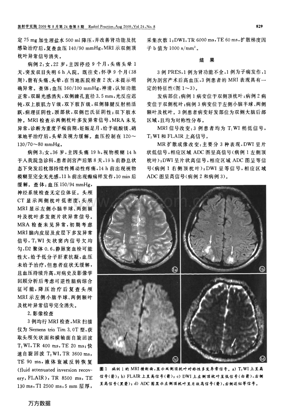 脑后部可逆性脑病综合征的MRI及DWI特点.pdf_第2页