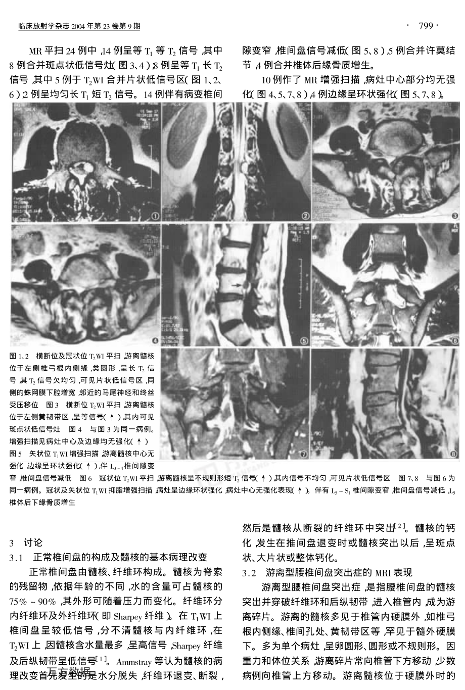 游离型腰椎间盘突出的MRI表现.pdf_第2页