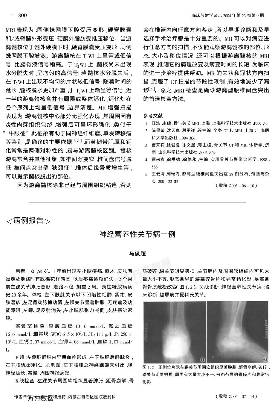 游离型腰椎间盘突出的MRI表现.pdf_第3页