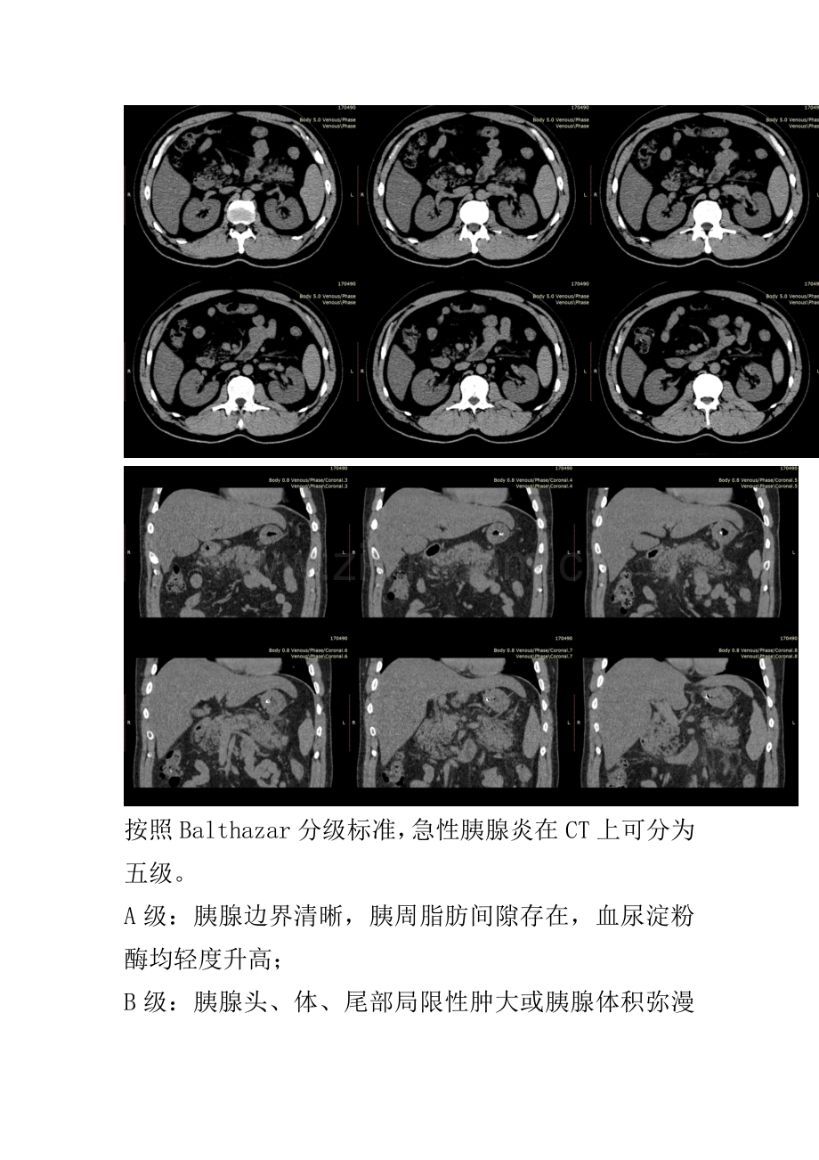 急性胰腺炎CT分级.doc_第3页