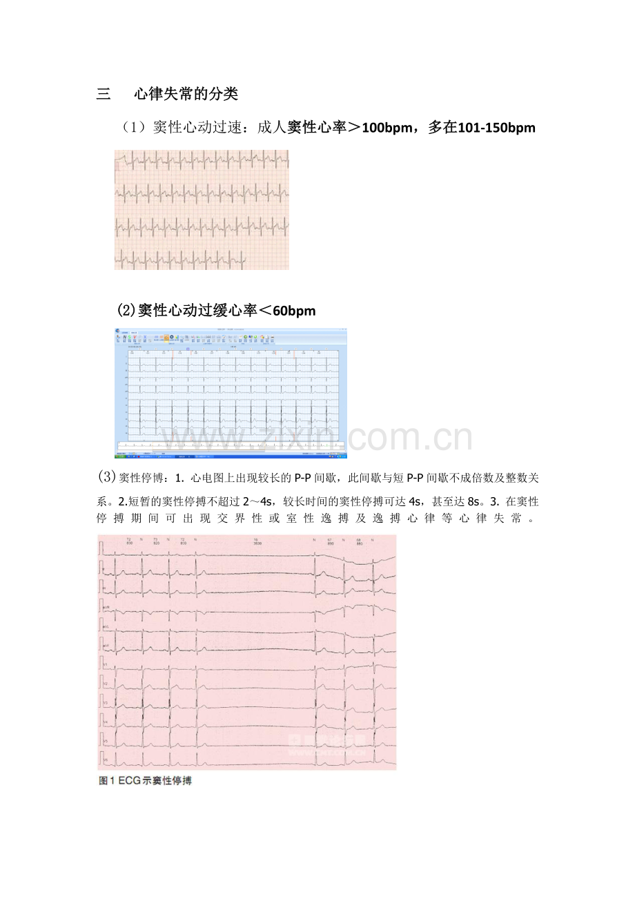 常见心律失常的心电图阅读.doc_第2页