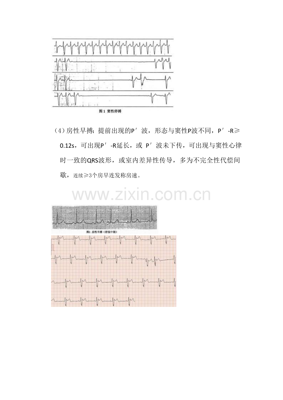 常见心律失常的心电图阅读.doc_第3页