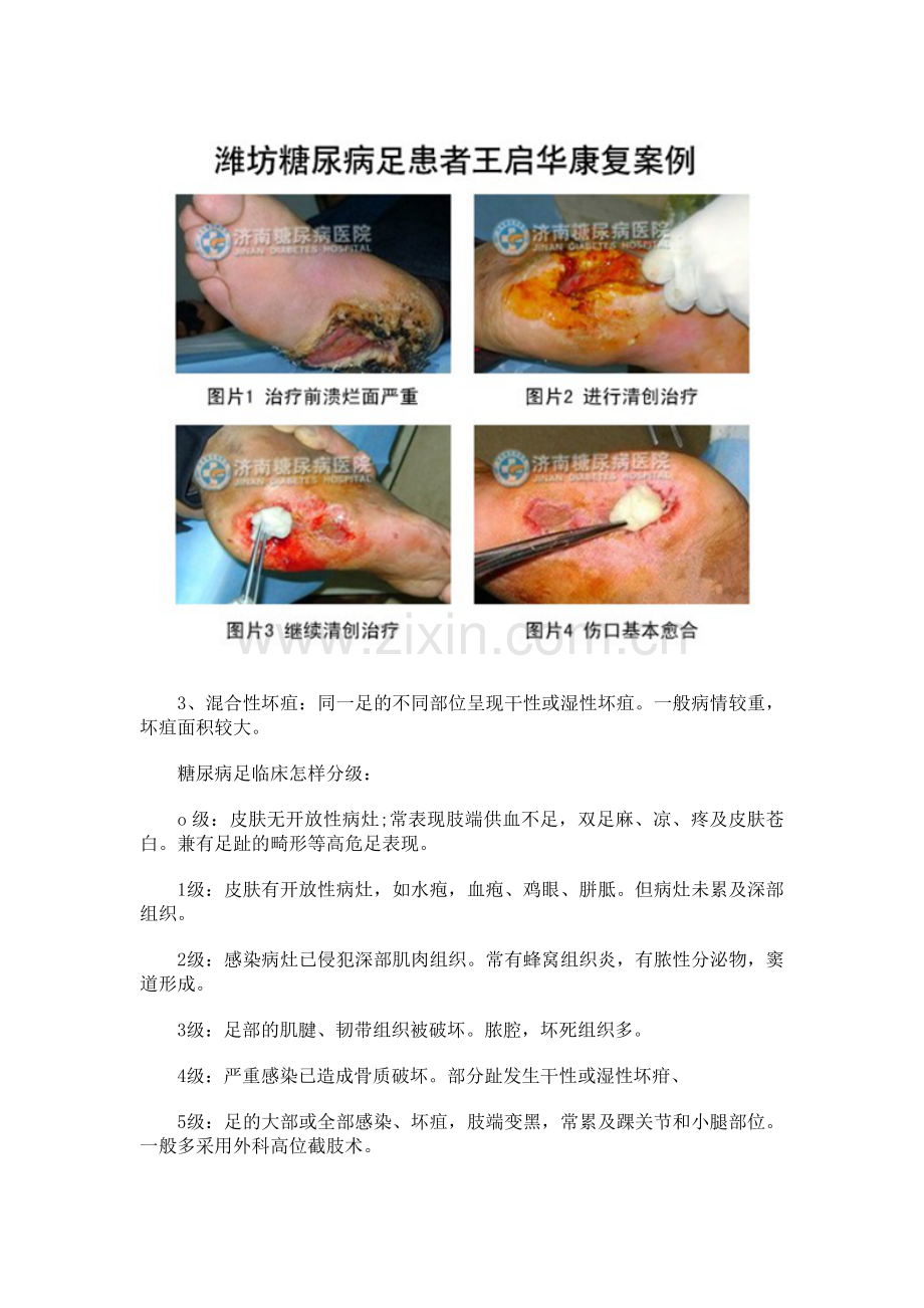 糖尿病足的症状及医治.doc_第2页