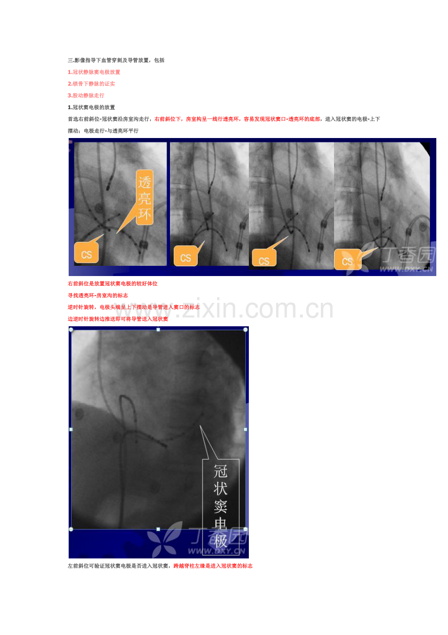 心脏电生理介入扫盲贴.docx_第3页