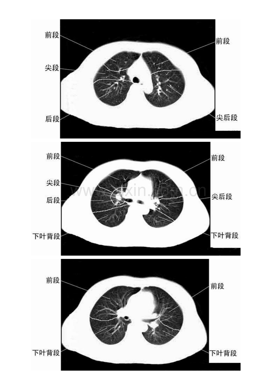 胸部CT肺段划分口诀.docx_第2页