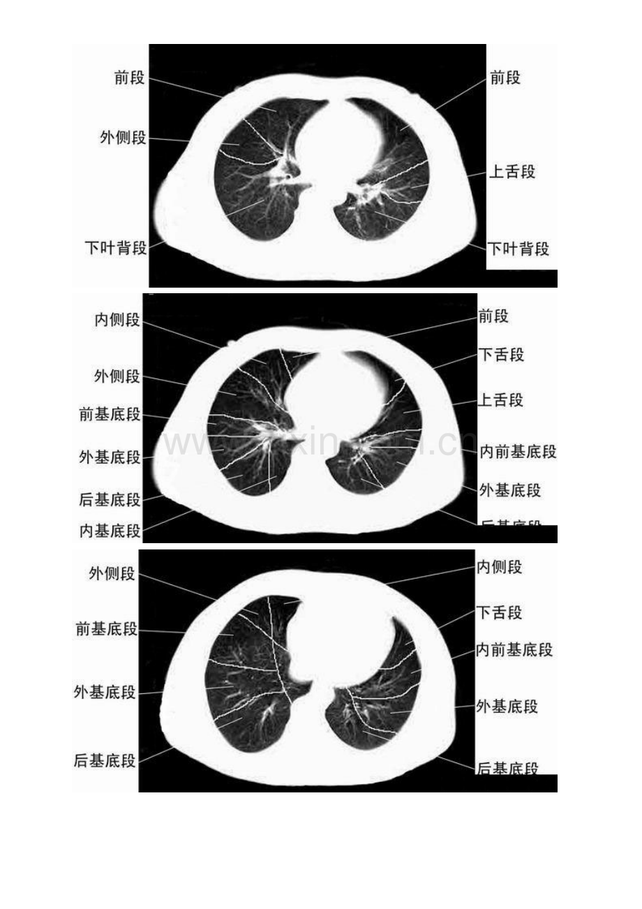 胸部CT肺段划分口诀.docx_第3页