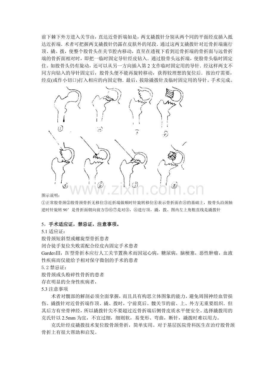 克氏针撬拨技术在闭合复位股骨颈骨折中的运用.doc_第2页