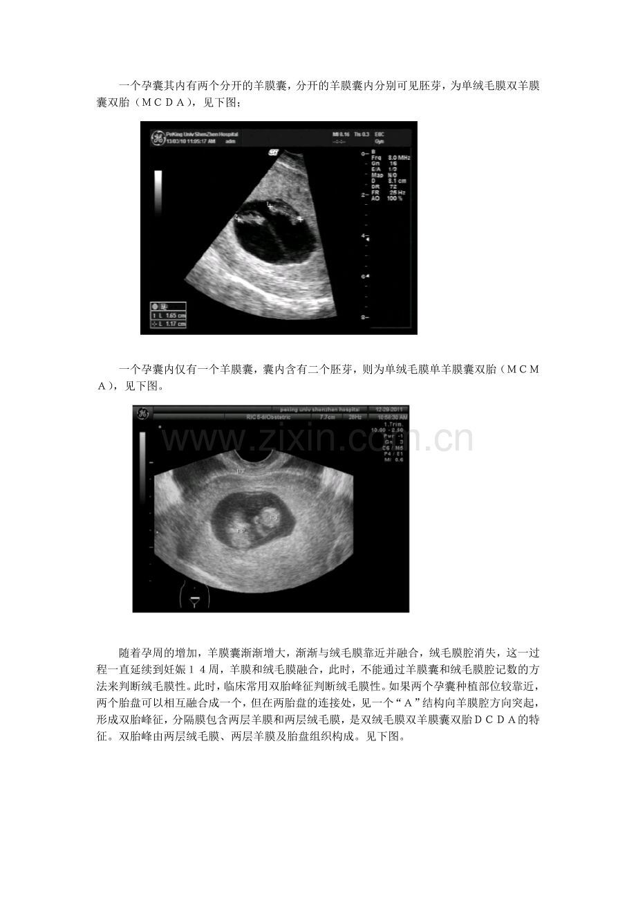 双胎妊娠.doc_第2页