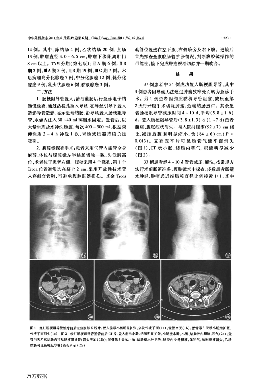 经肛肠梗阻导管联合腹腔镜手术治疗结直肠恶性梗阻.pdf_第2页