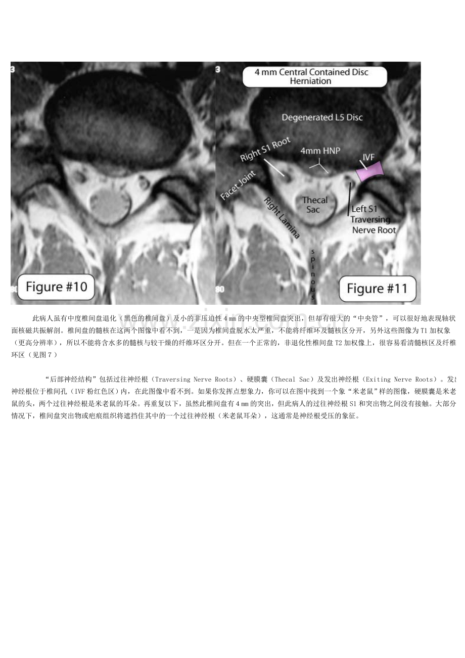 怎样看椎间盘CT_MRI_片.doc_第3页