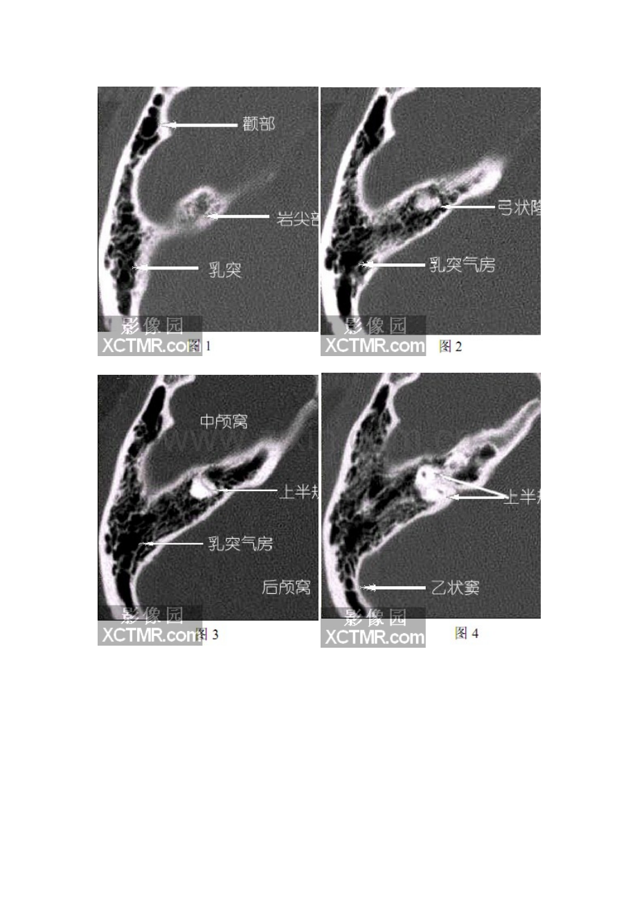 耳部-颞骨轴位HRCT解剖(图文).doc_第2页