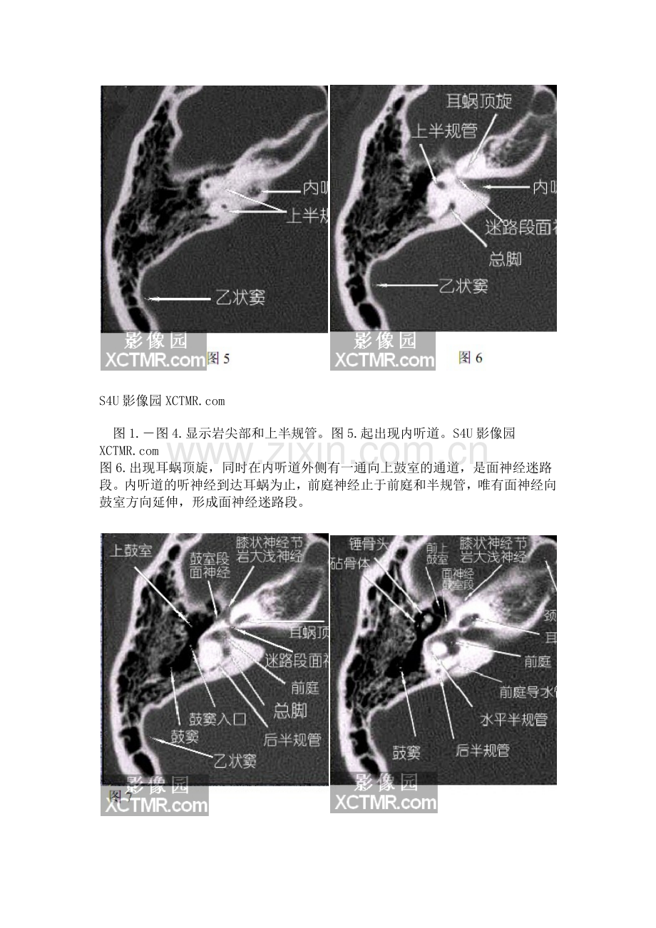 耳部-颞骨轴位HRCT解剖(图文).doc_第3页