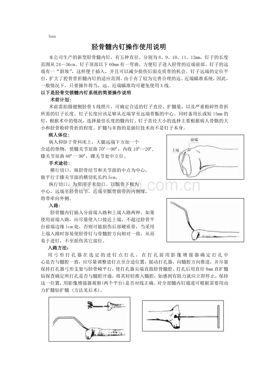 胫骨髓内钉操作使用说明.doc_第1页