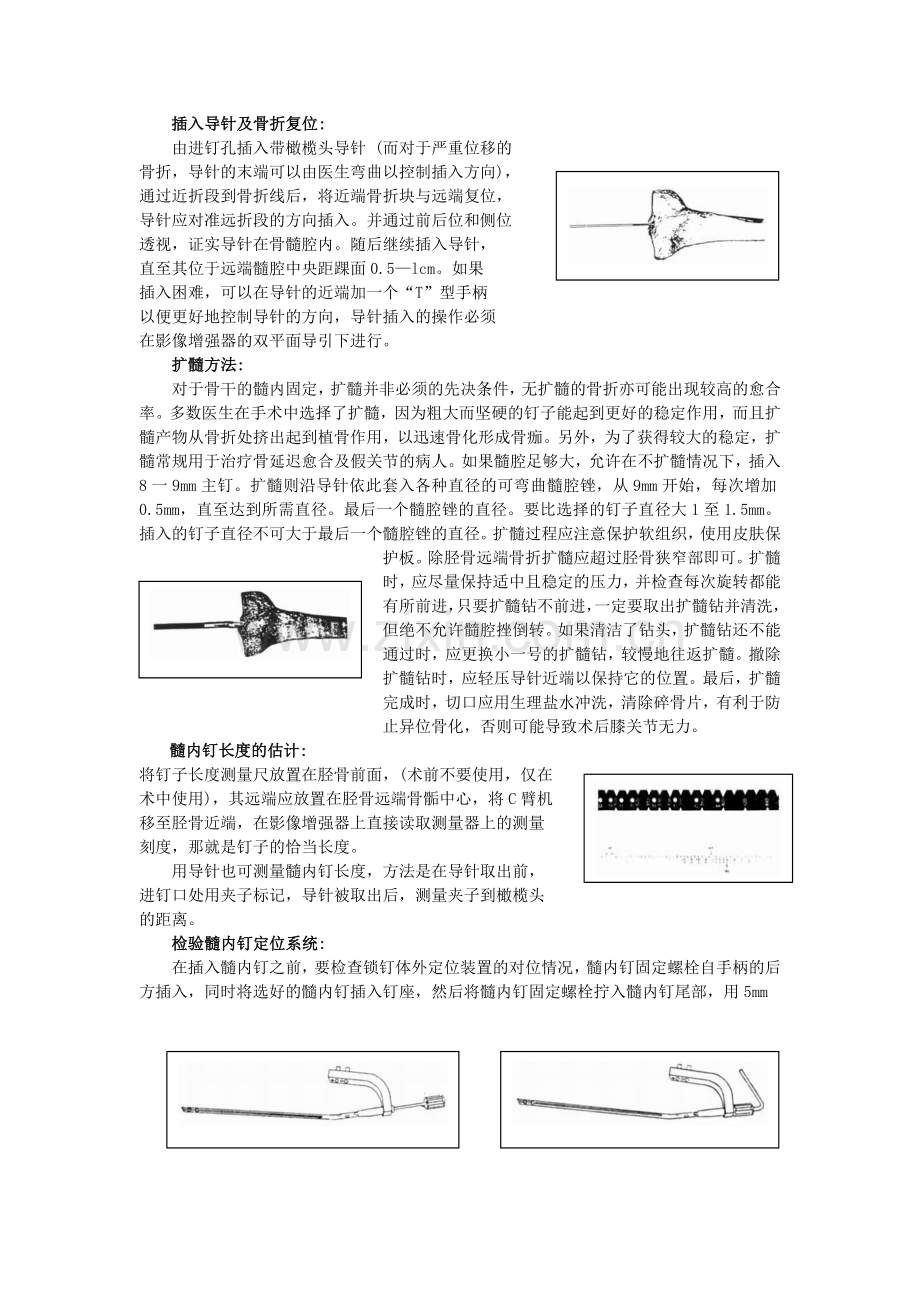 胫骨髓内钉操作使用说明.doc_第2页