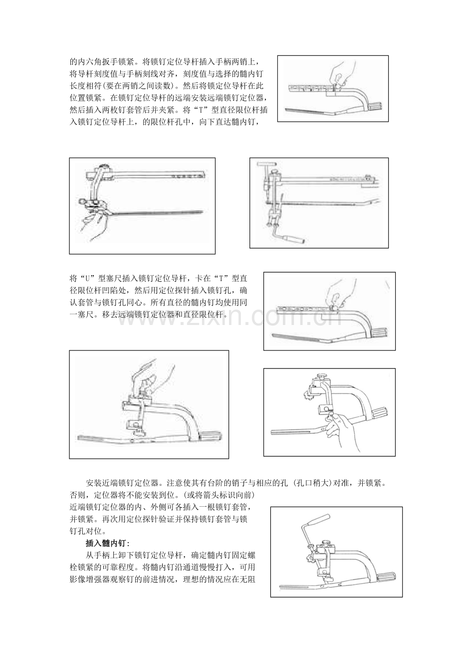 胫骨髓内钉操作使用说明.doc_第3页