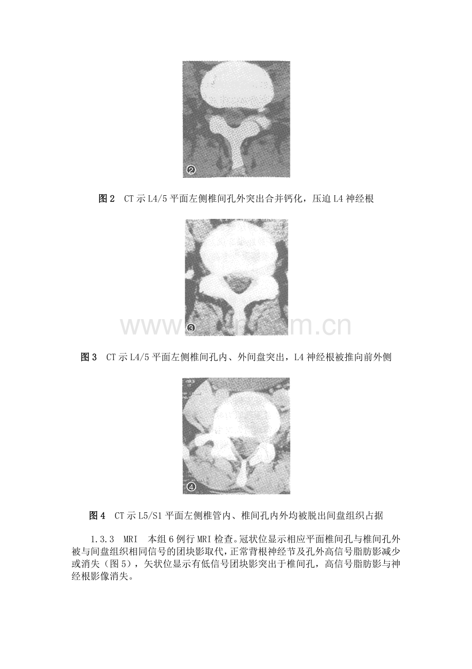 椎间孔与椎间孔外腰椎间盘突出症的诊断与治疗.doc_第3页