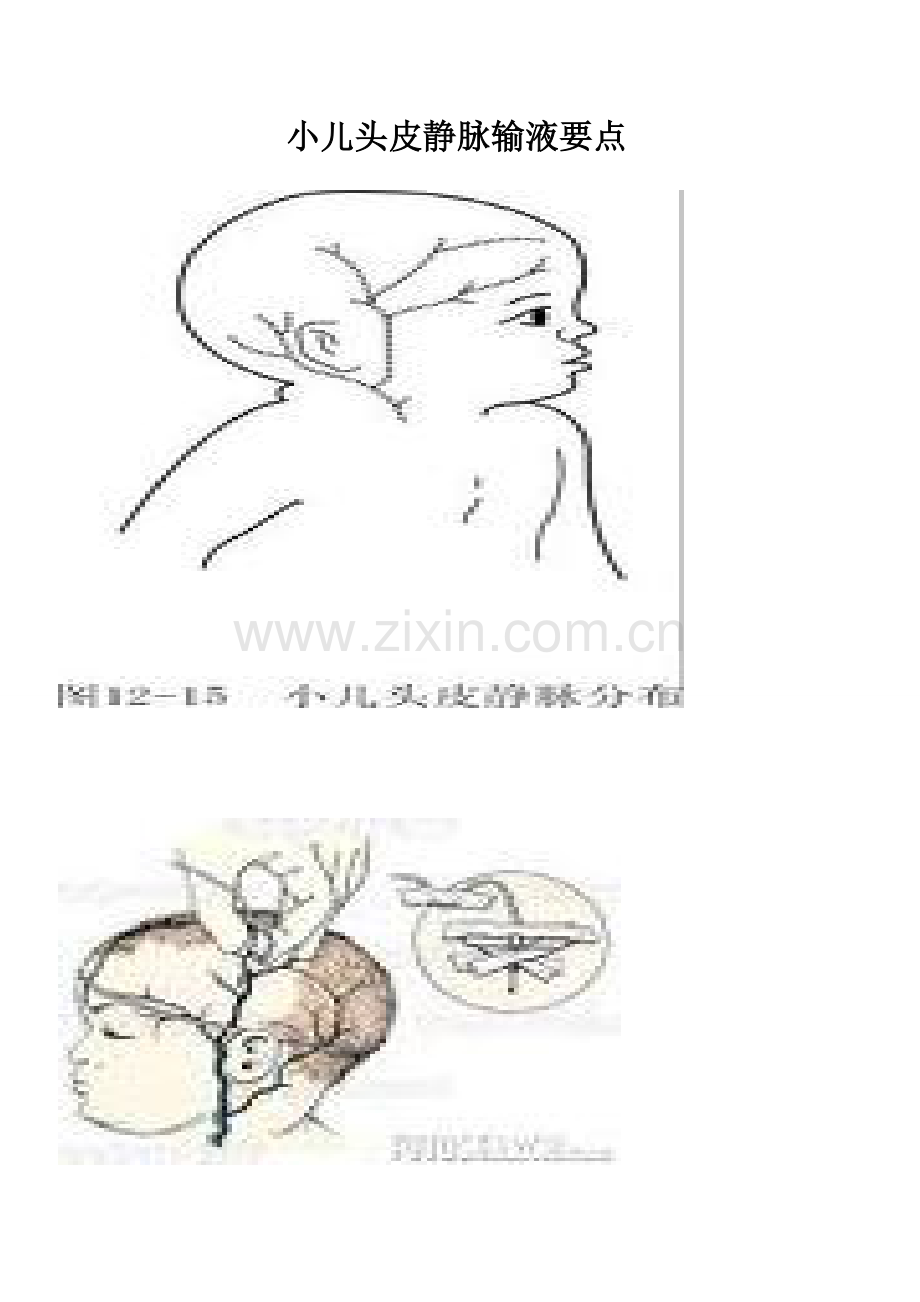 小儿头皮静脉要点讲课.doc_第1页