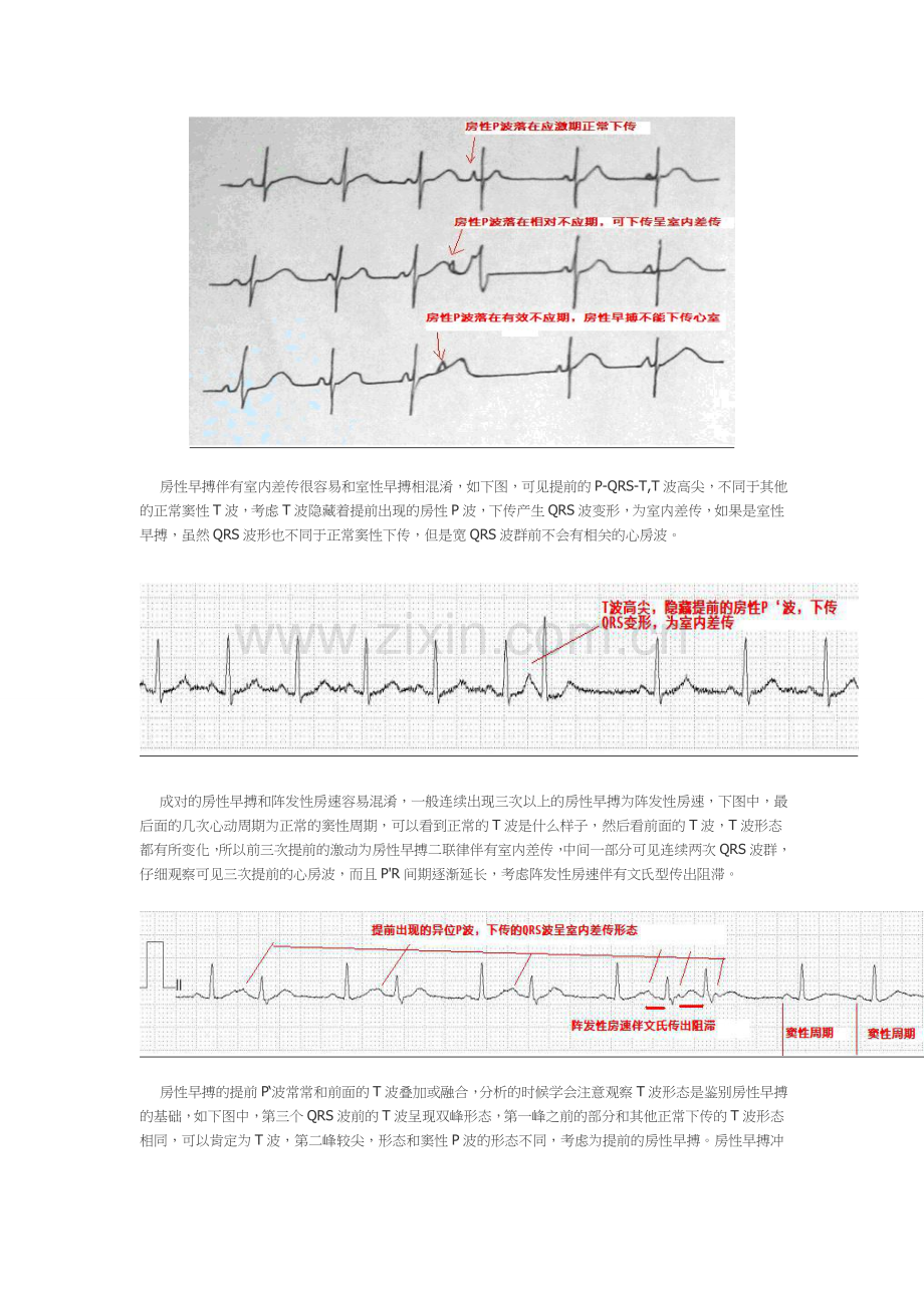 早搏的诊断和鉴别诊断.doc_第3页