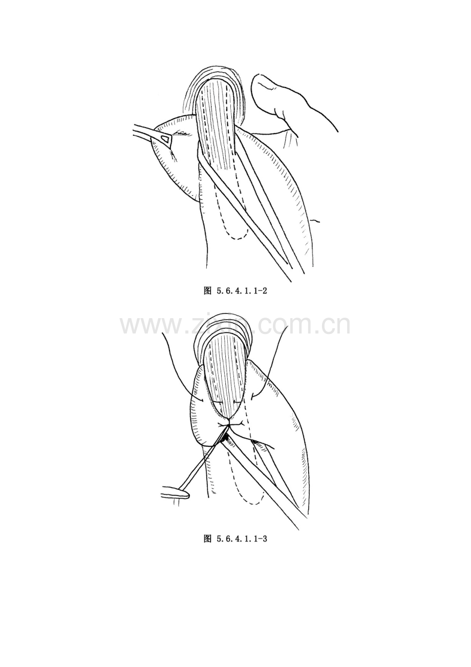 Nissen手术.pdf_第3页