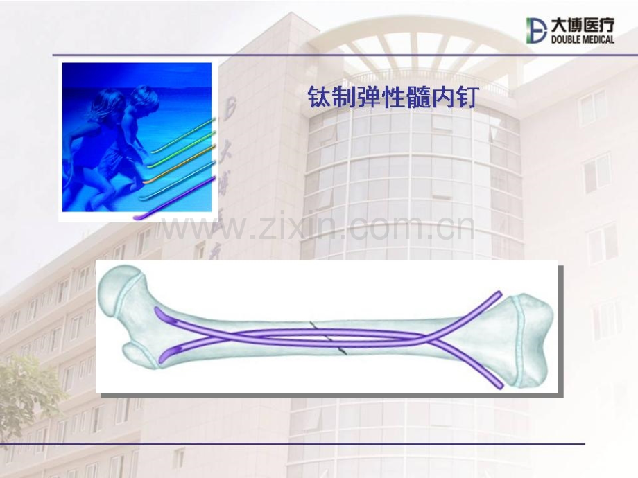 弹性髓内钉治疗儿童骨折操作技巧PPT.pptx_第1页