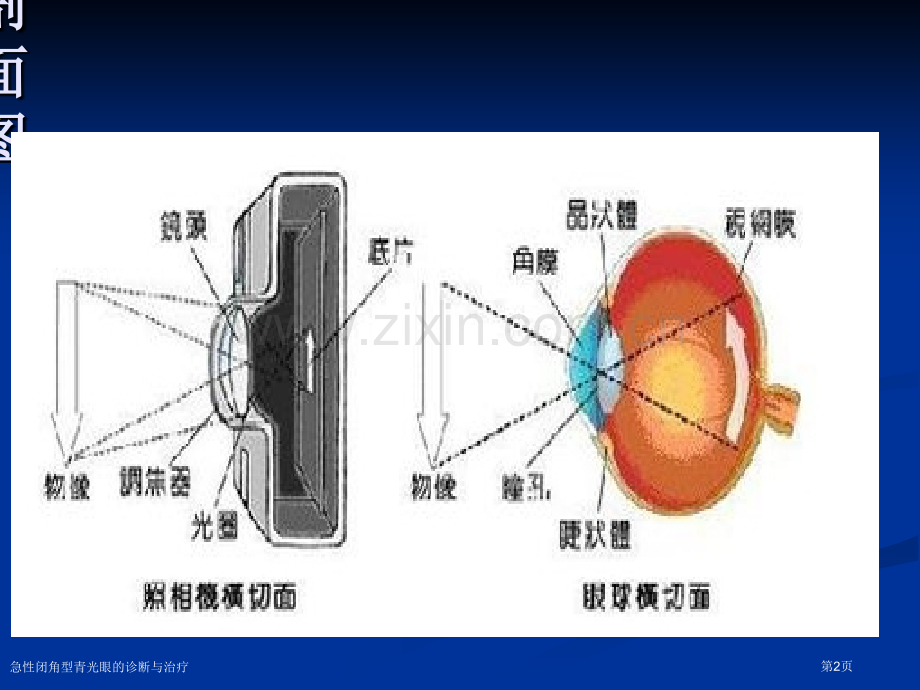 急性闭角型青光眼的诊断与治疗.pptx_第2页