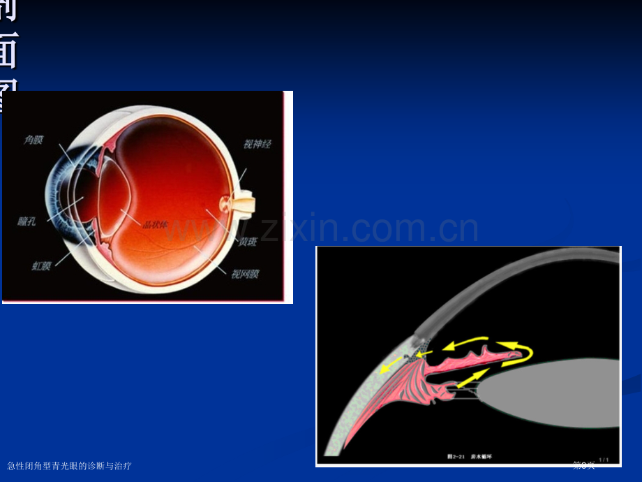 急性闭角型青光眼的诊断与治疗.pptx_第3页
