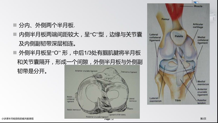 小讲课半月板损伤的磁共振表现.pptx_第2页