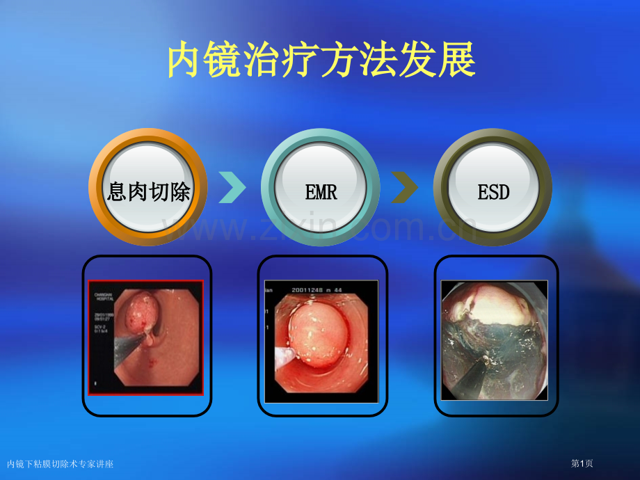 内镜下粘膜切除术专家讲座.pptx_第1页