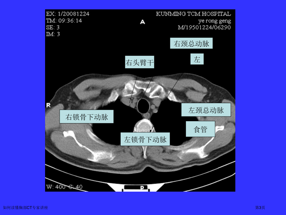如何读懂胸部CT专家讲座.pptx_第3页