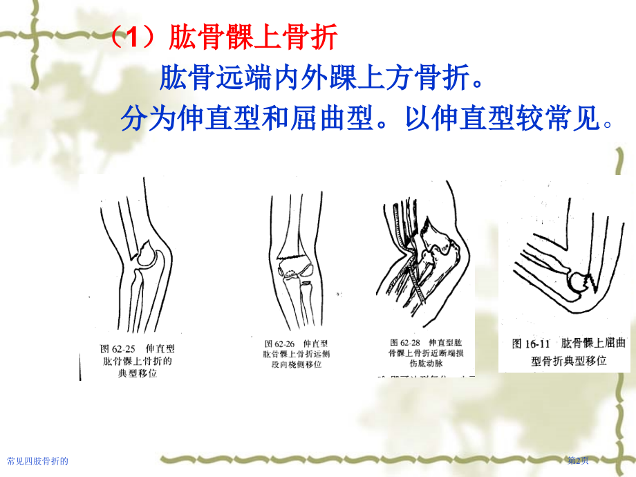 常见四肢骨折的.pptx_第2页