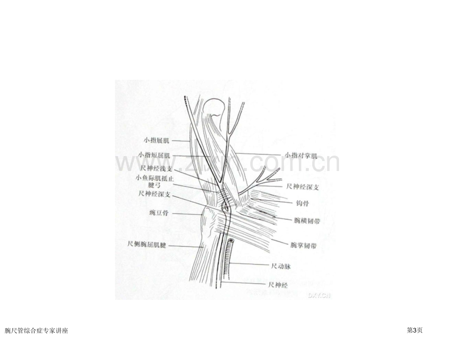 腕尺管综合症专家讲座.pptx_第3页