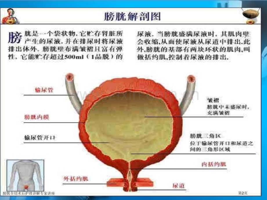 膀胱全切术后护理详解专家讲座.pptx_第2页