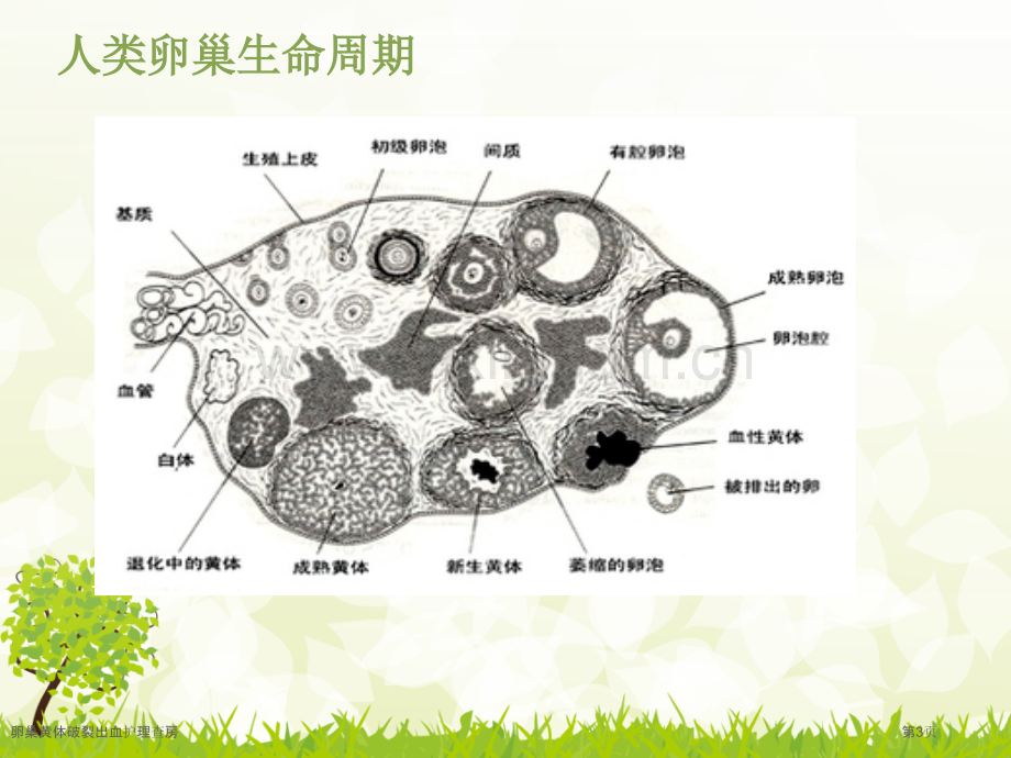 卵巢黄体破裂出血护理查房.pptx_第3页