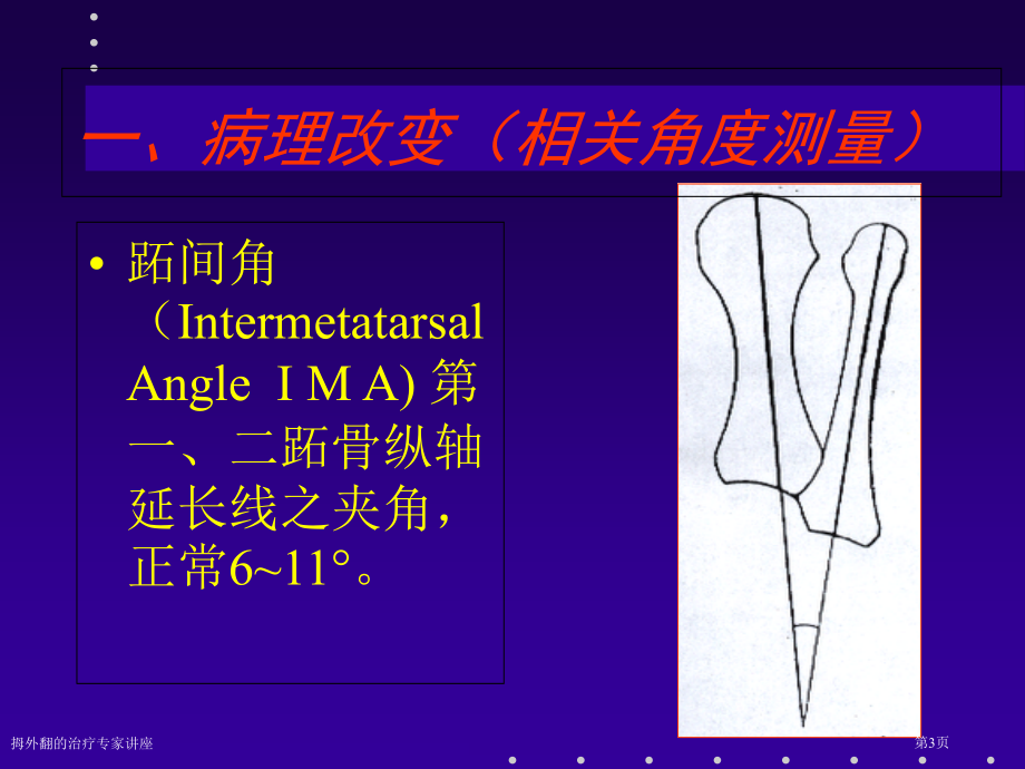 拇外翻的治疗专家讲座.pptx_第3页