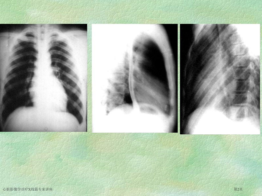 心脏影像学诊疗X线篇专家讲座.pptx_第2页
