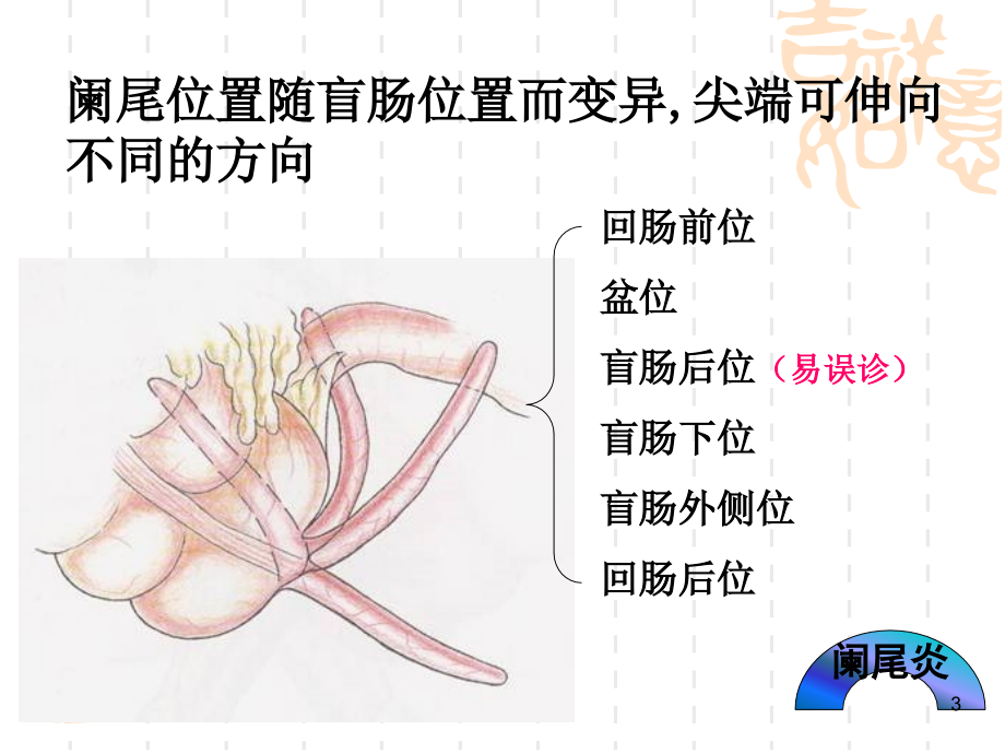 阑尾炎PPT参考课件.ppt_第3页