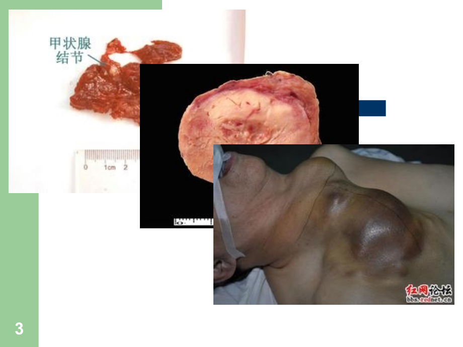 甲状腺结节需要外科评估课件.ppt_第3页