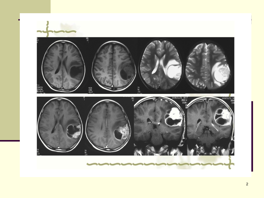 脑实质内室管膜瘤(课堂PPT).ppt_第2页