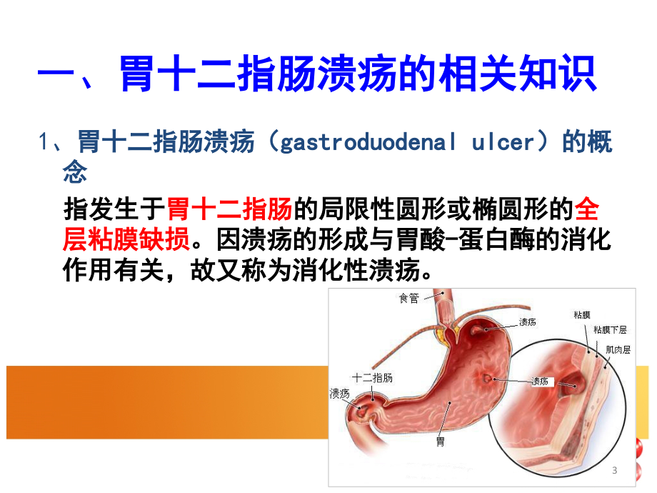 胃十二指肠溃疡病人的-护理(课堂PPT).ppt_第3页