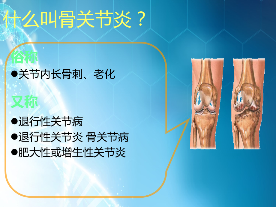 膝关节骨性关节炎的分级治疗.ppt_第2页