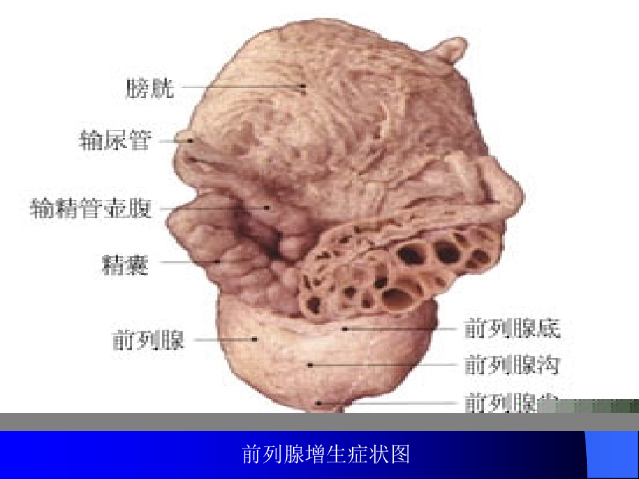 经尿道前列腺电切术的健康教育.ppt_第3页