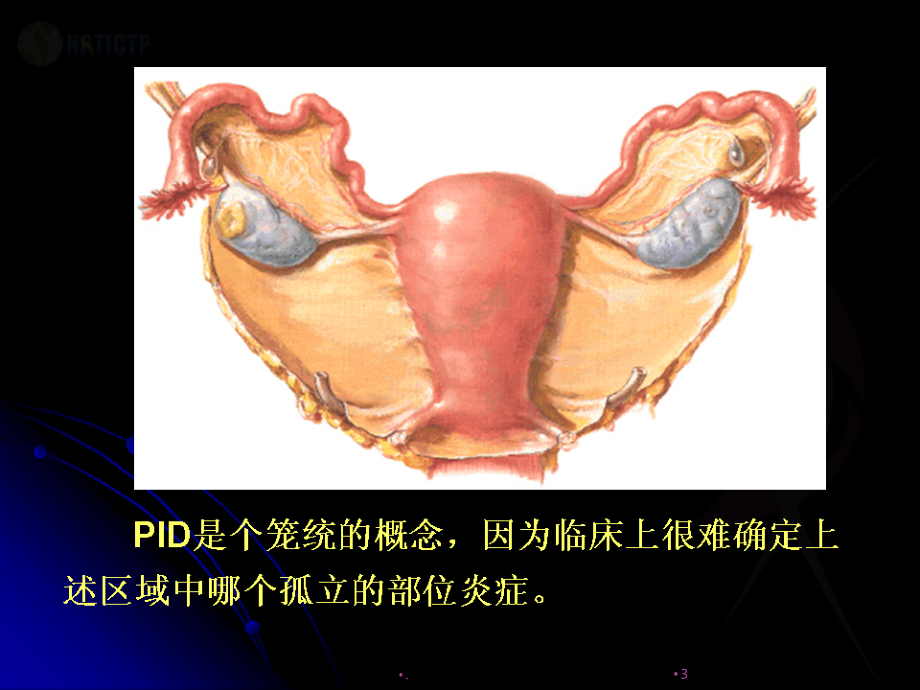 盆腔炎性疾病诊治新规范课件.ppt_第3页