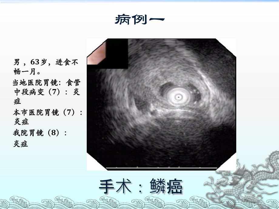 消化道隆起性病变的超声内镜诊断ppt课件.ppt_第2页